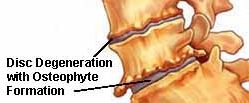 Osteophyte